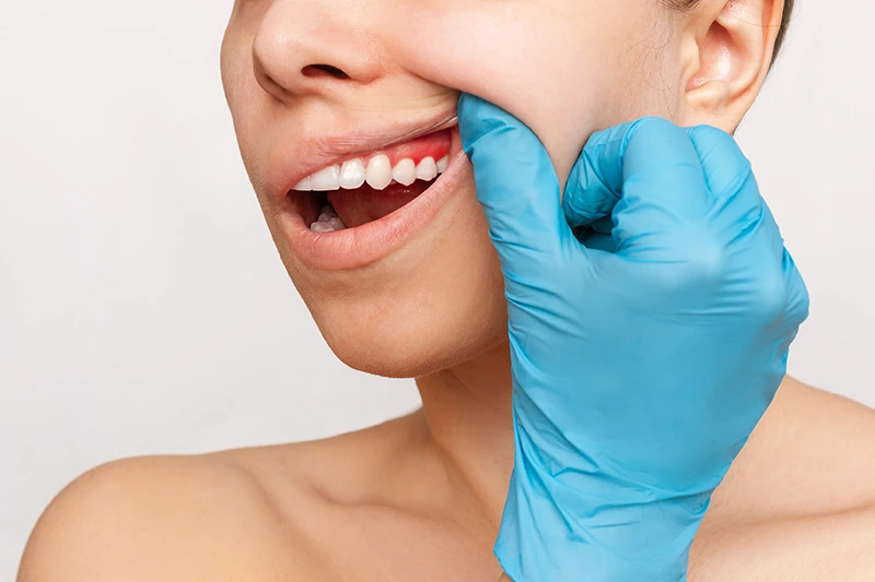 diş eti estetiği Kuşadası