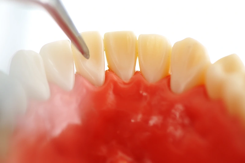 diş eti temizliği Kuşadası