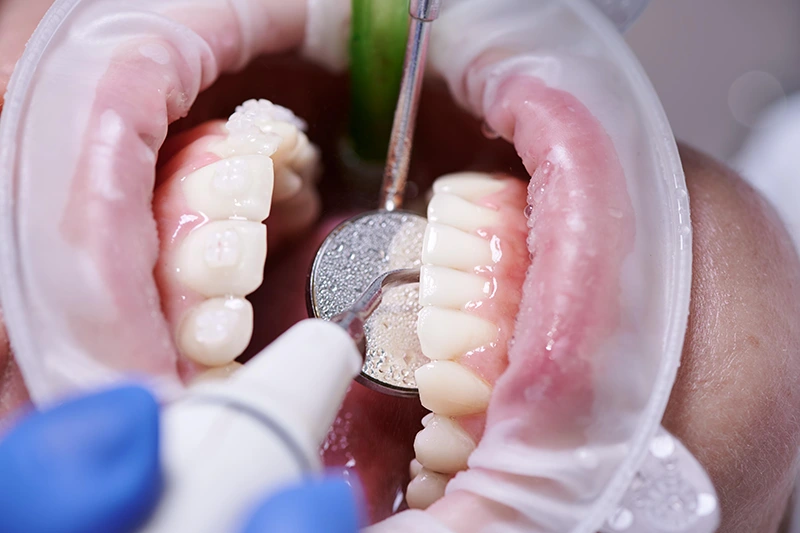 diş taşı temizliği Kuşadası