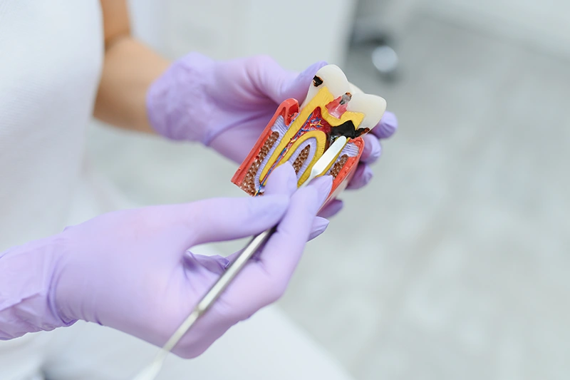 kanal tedavisi nasıl yapılır